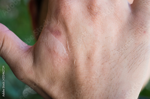 burning pain wound from burn on man's hand,
