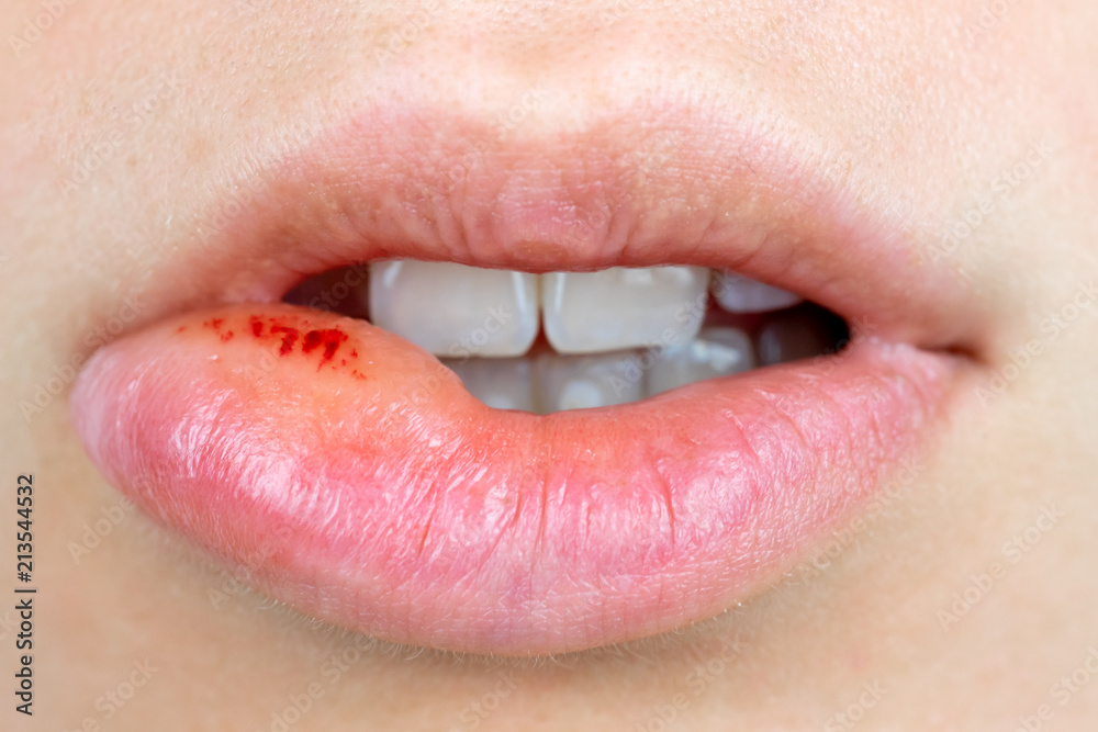 Orale Lippen Herpes Infektion, / Lippe aufgebissen, Stock Photo