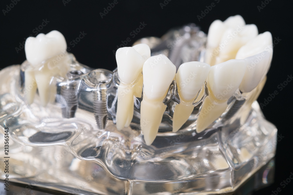 implant and orthodontic model for student to learning teaching model showing teeth. implant and orthodontic model for student to learning teaching model showing teeth.