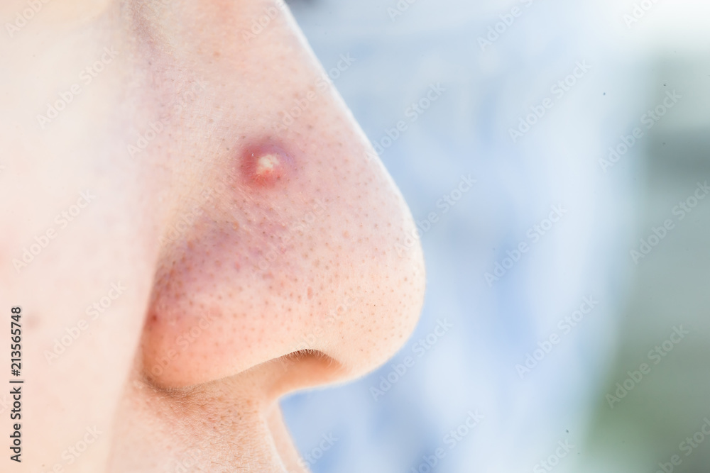 Fototapeta premium close up of facial acne