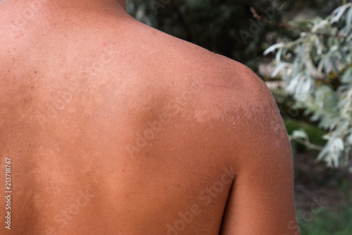 Valokuvatapetti Sunburn on the skin of the back