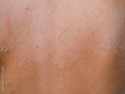 Sunburn on the skin of the back. Exfoliation  skin peels off. Dangerous sun tan
