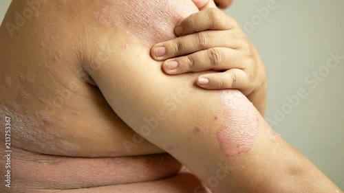 Men is their hands to scratch the wound. Diseases caused by abnormalities of the lymph. Psoriasis is a skin disease.