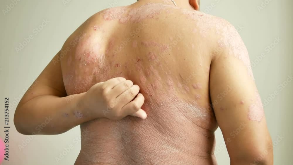 Men is their hands to scratch the wound. Diseases caused by abnormalities of the lymph. Psoriasis is a skin disease. Men is their hands to scratch the wound. Diseases caused by abnormalities of the lymph. Psoriasis is a skin disease.