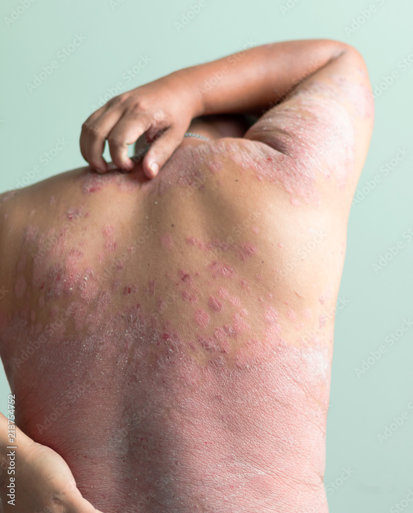 Fototapeta premium Diseases caused by abnormalities of the lymph