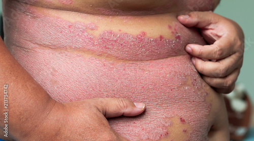 Men is holding the belly and scratching the area of psoriasis