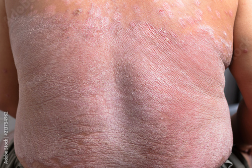 The back is full of psoriasis