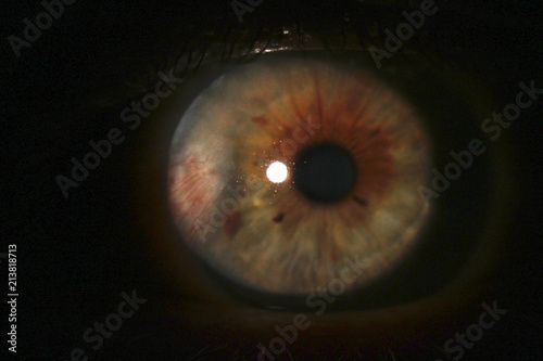  Human eye with cataract. Investigation and test of the eye fundus of the human eye. The pathology of the eye is cataract. large scale photo 