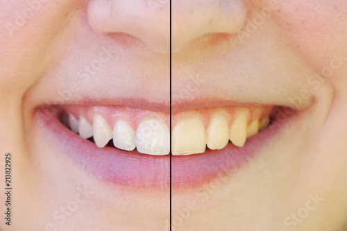 teeth whitening before and after concept. comparision between yellow and white teeth side by side.