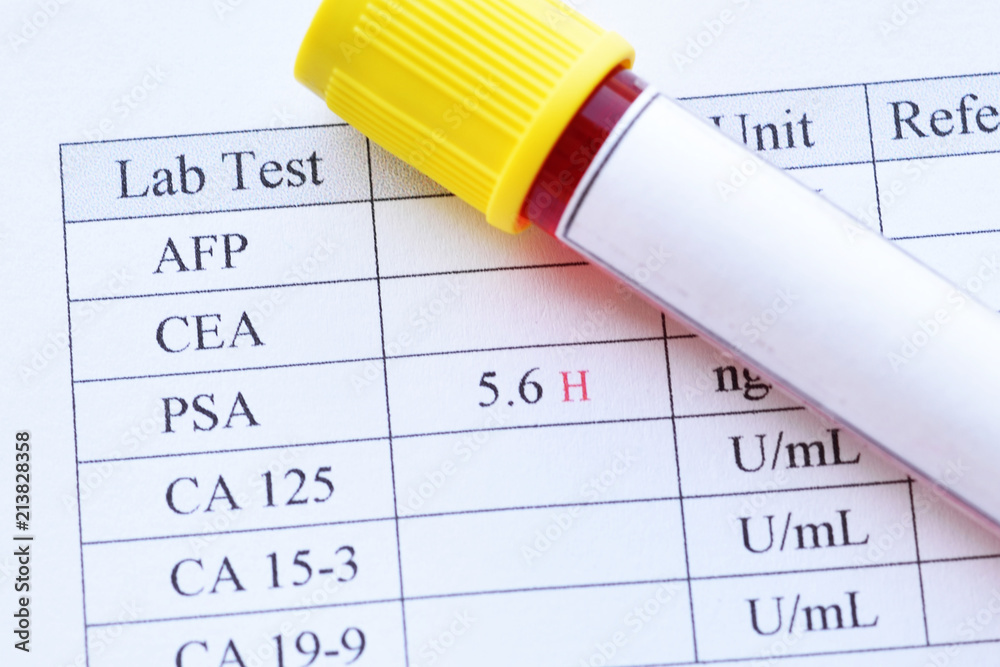 Abnormal High PSA Test Result With Blood Sample Tube Stock Photo   1000 F 213828358 KVgMA1mmNG0ZW8oz5Gl1odkb3oYfkmXu 