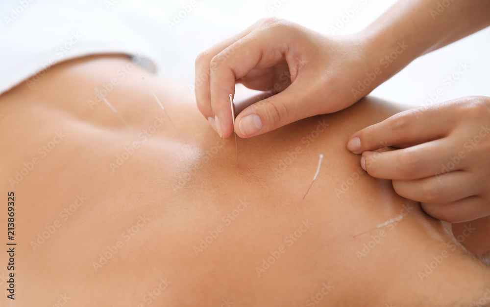Young woman undergoing acupuncture treatment in salon, closeup - obrazy, fototapety, plakaty 