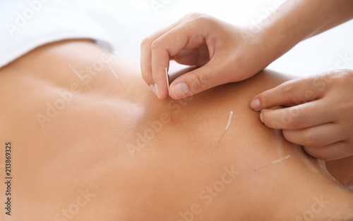 Young woman undergoing acupuncture treatment in salon  closeup