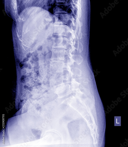 X-ray of the pelvis and spinal column ,side view