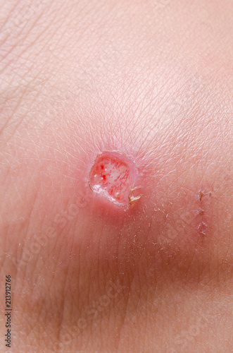 Purulent wound on the skin of a person on the leg close-up