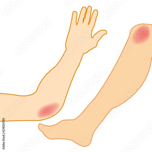 Hand and leg pain