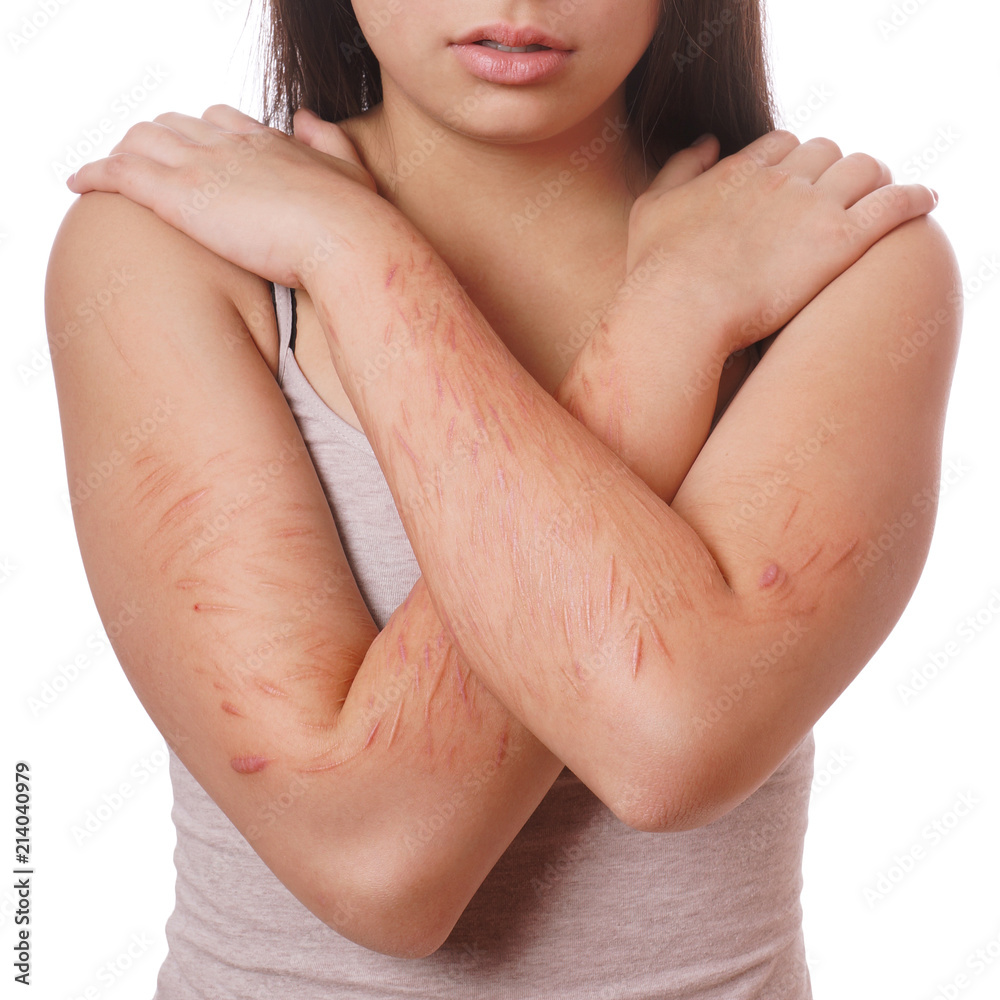 arms with scars and cuts from deliberate self-harm Stock Photo | Adobe Stock