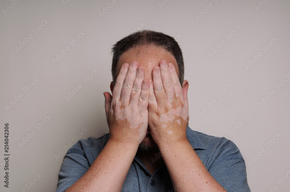 man affected by Vitiligo skin condition hiding his face man affected by Vitiligo skin condition hiding his face