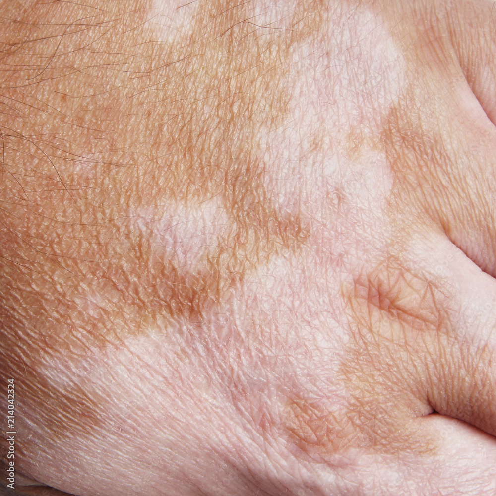 Vitiligo is a medical condition causing depigmentation of patches of skin Vitiligo is a medical condition causing depigmentation of patches of skin