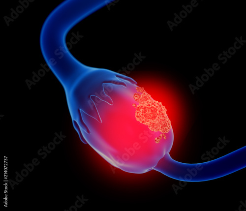 3d illustration of ovarian cancer