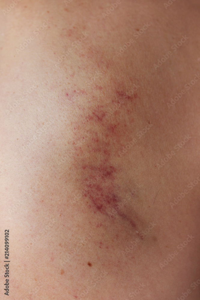 bruises that remain after the ancient Chinese method of massage with a scraper. back area bruises that remain after the ancient Chinese method of massage with a scraper. back area