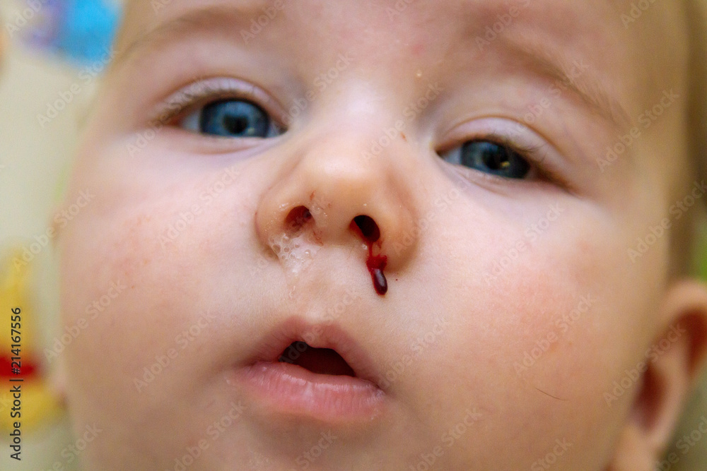 Close Up of a Bloody and Runny Nose of a Baby Two Days After His