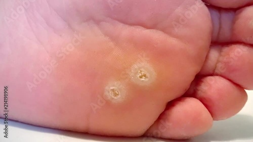 Wart verrucas plantar. Fasciitis Wart on foot. Decease on foot skin. Wart plantaR callus foot photo