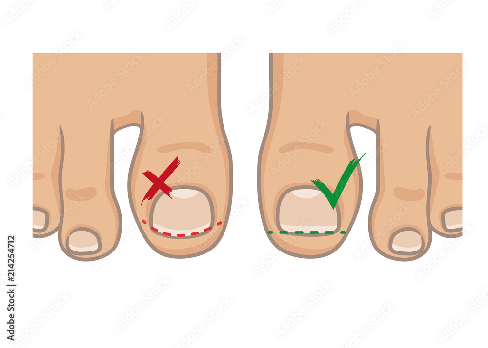 How to cut toenails, right and wrong concept. How to avoide ingrown nail.  Female or male foot sole, barefoot, top view. Vector illustration, hand  drawn cartoon style isolated on white. Stock Vector |