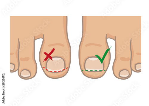 How to cut toenails, right and wrong concept. How to avoide ingrown nail. Female or male foot sole, barefoot, top view. Vector illustration, hand drawn cartoon style isolated on white.