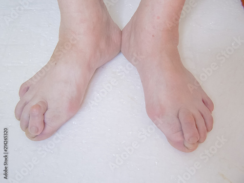 Bare foots which have Hallux Valgus problem. © Irina