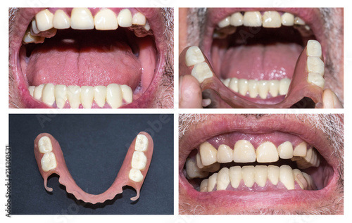 Dental rehabilitation with upper and lower prosthesis, before and after treatment photo