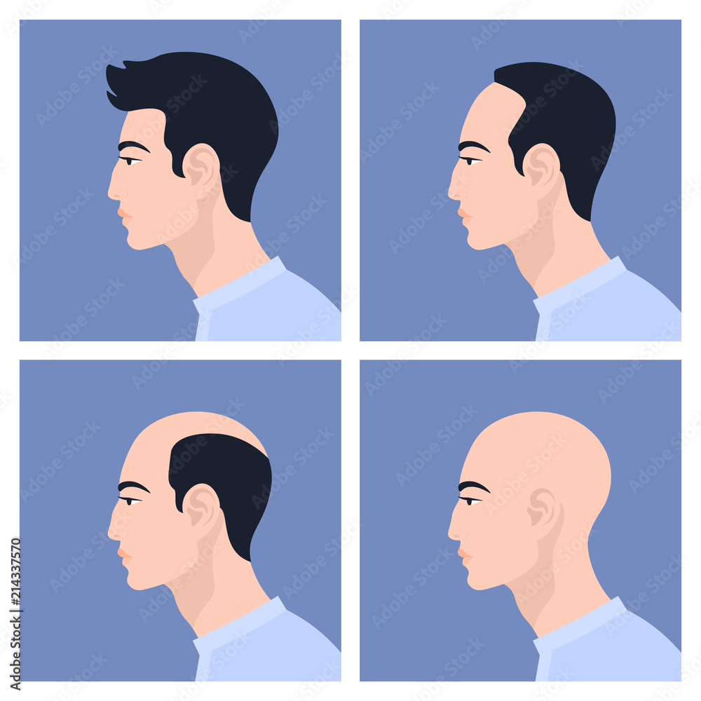 Stages of male pattern baldness. Hair loss. Alopecia. Asian men. Vector  Flat Illustration Stock Vector | Adobe Stock