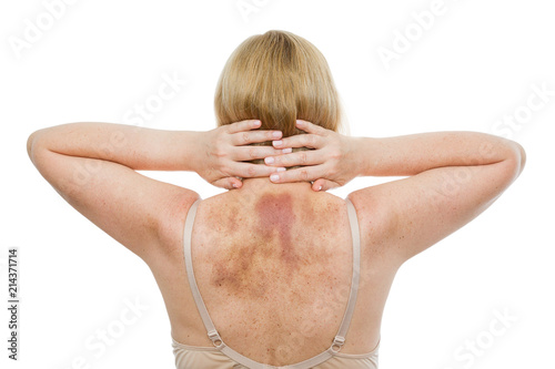 A bruise on the back, a woman with extensive hematoma after a massage