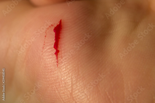 Billede på lærred Hand of man injured wound from accident and blood bleeding on white background ,