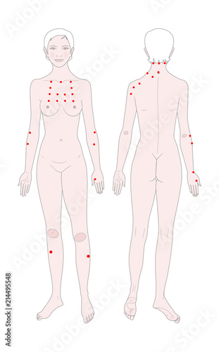  Acupuncture. Treatment of osteochondrosis. Templates of a woman's figure with points for massage. Front view and back. Vector illustration.