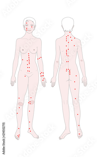  Acupuncture. Treatment of osteochondrosis. Templates of a woman's figure with points for massage. Front view and back. Vector illustration.