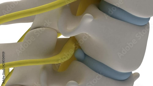 Anatomically accurate 3d animation of cervical spine with prolapse of intervertebral disc compressive nerve root isolated on white background