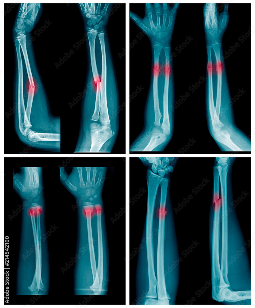 Collection of Xray image of Forearm bone fracture in child's (Radius