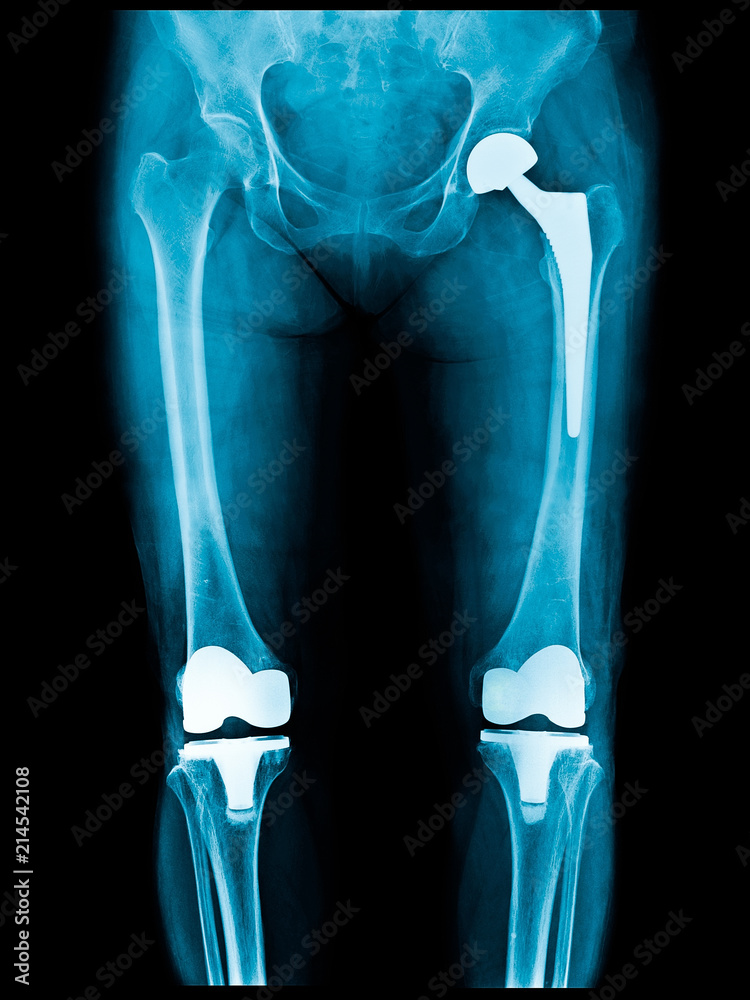Stockfoto Xray scan of patient who have hip replacement and knee