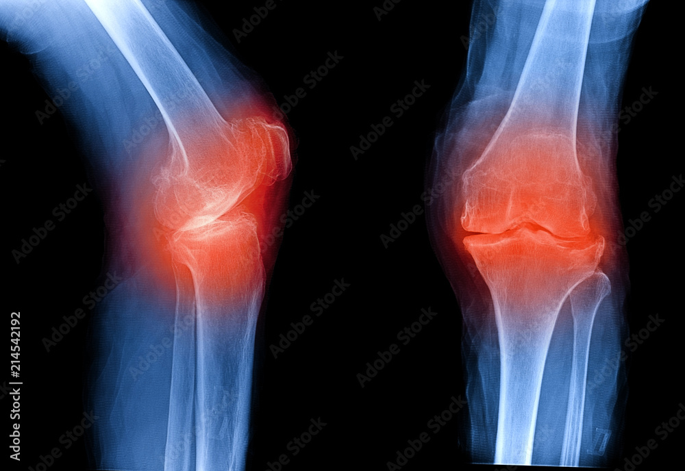 Osteoarthritis knee . film xray AP ( anterior posterior ) and