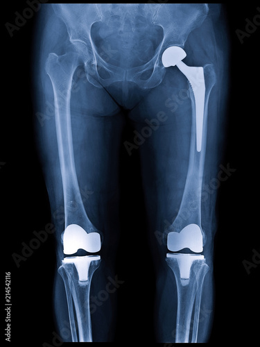 Xray scan of patient who have hip replacement and knee arthroplasty (knee replacement) treatment for Osteoarthritis knee, hip arthritis, Osteonecrosis of Hip. After surgery patient can walk normally