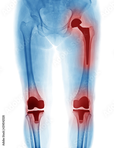 X Ray image of hip replacement and knee replacement isolated on white background
