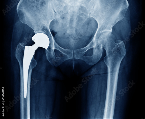 X-ray scan image of hip joints with orthopedic hip joint replacement or total hip prosthesis on right side implant head and screws in human skeleton in blue gray tones. photo