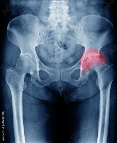 X-ray image of chronic painful hip in woman present Osteoarthritis left hip joint at red area mark
