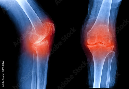 Osteoarthritis knee . film x-ray AP ( anterior - posterior ) and lateral view show narrow joint space, osteophyte ( spur ), subchondral sclerosis, inflammation, OA photo