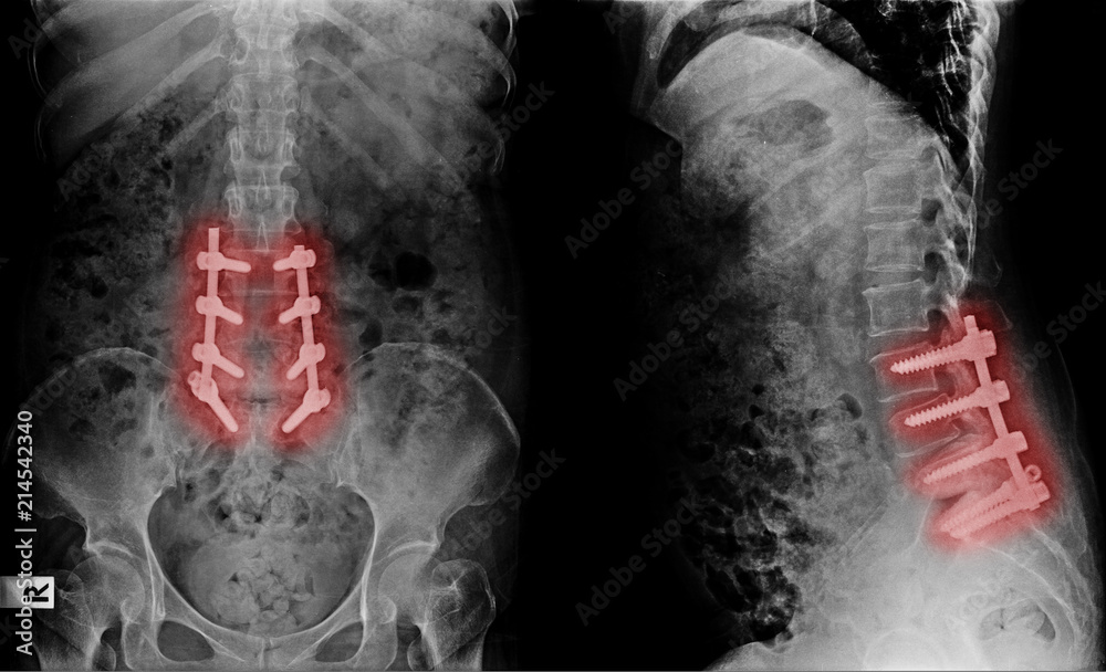 Xray image of lumbar spine postoperative treatment for degenerative