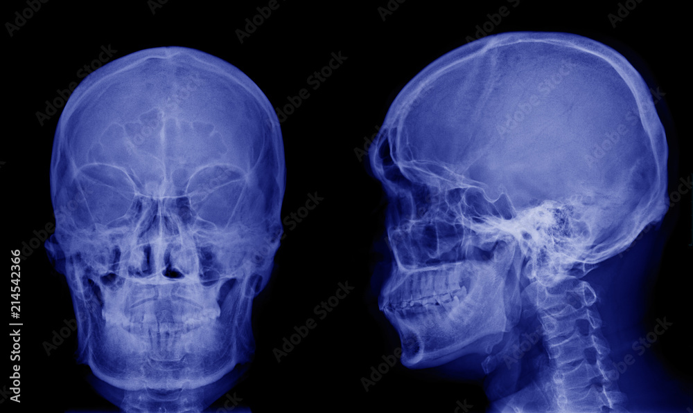 X-ray image of asian skull front view and side view X-ray image of asian skull front view and side view