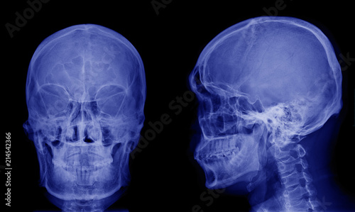 X-ray image of asian skull front view and side view