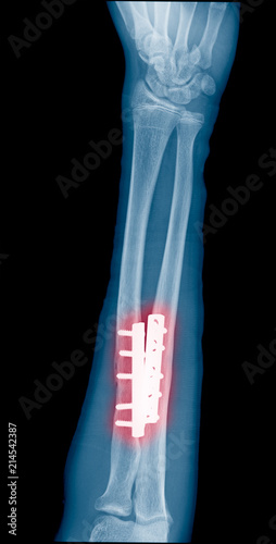 X-ray image of adult forearm show fracture at ulnar and radius fix by plate and screw