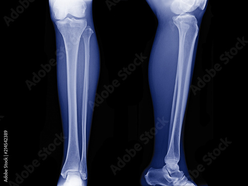 x-ray image of leg front view and side view , xray of normal leg bone in adult