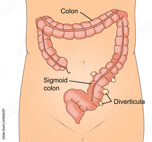 Diverticulitis